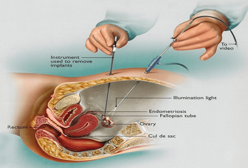 Laparoscopic Surgery